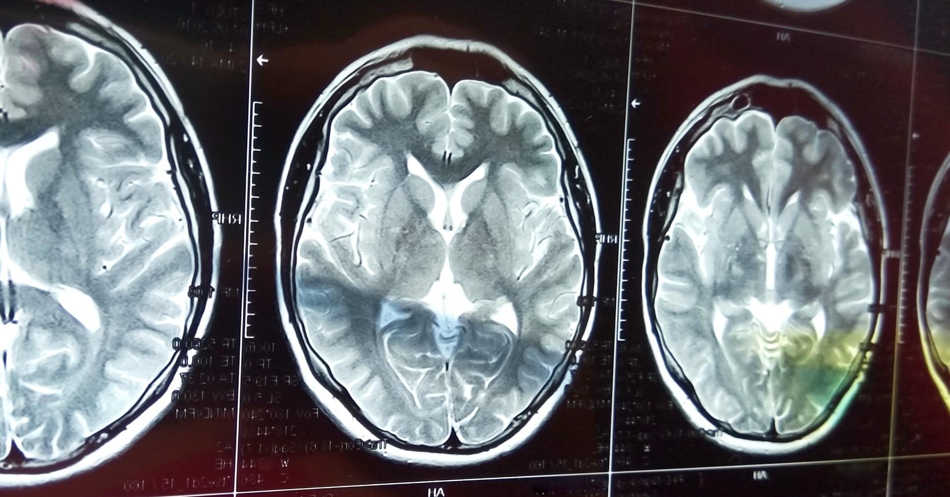 Wybrane zagadnienia z neuroradiologii