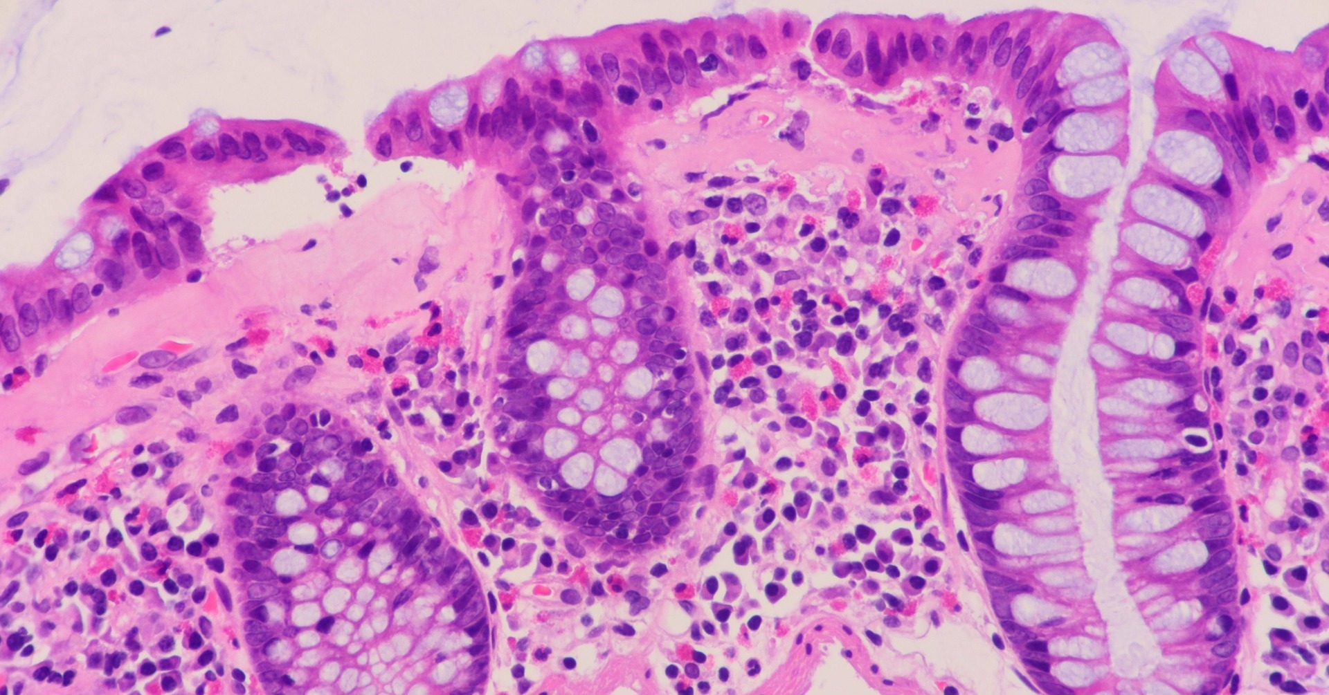 Patomorfologia najczęstszych zmian nowotworowych i nienowotworowych w przewodzie pokarmowym