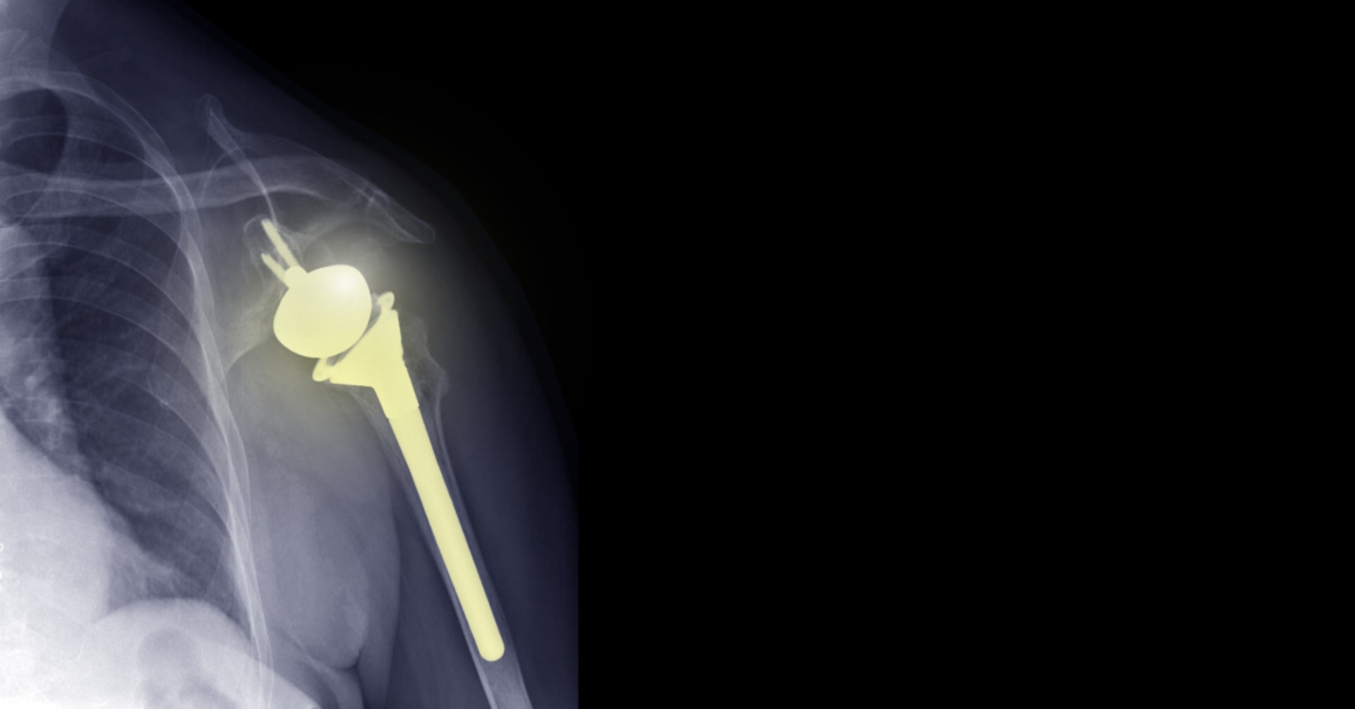 Endoprotezoplastyka barku – anatomiczna i odwrócona. Kurs kadawerowy