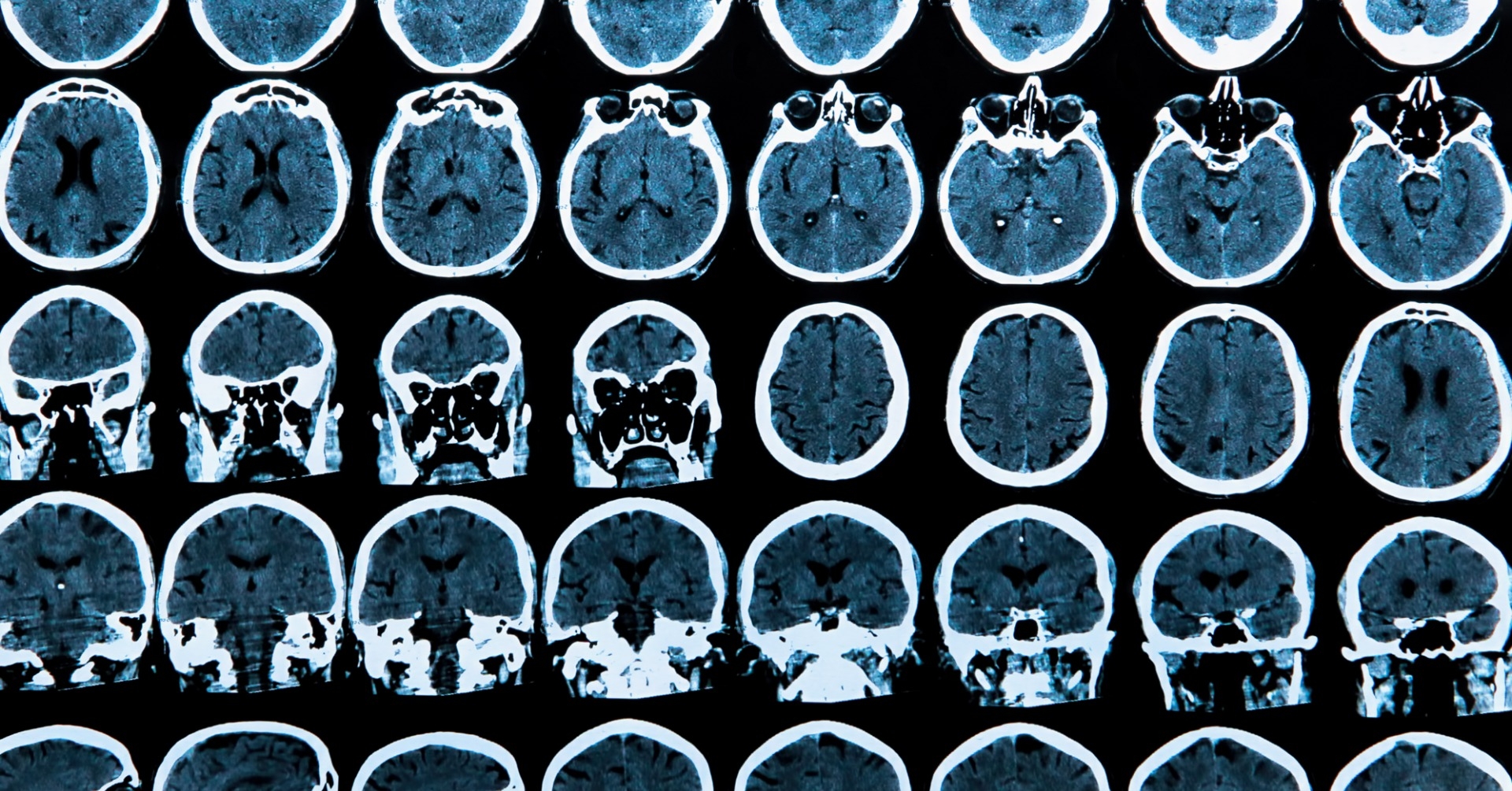 Neuroprotekcja i suplementacja – znaczenie kliniczne i wyniki badań
