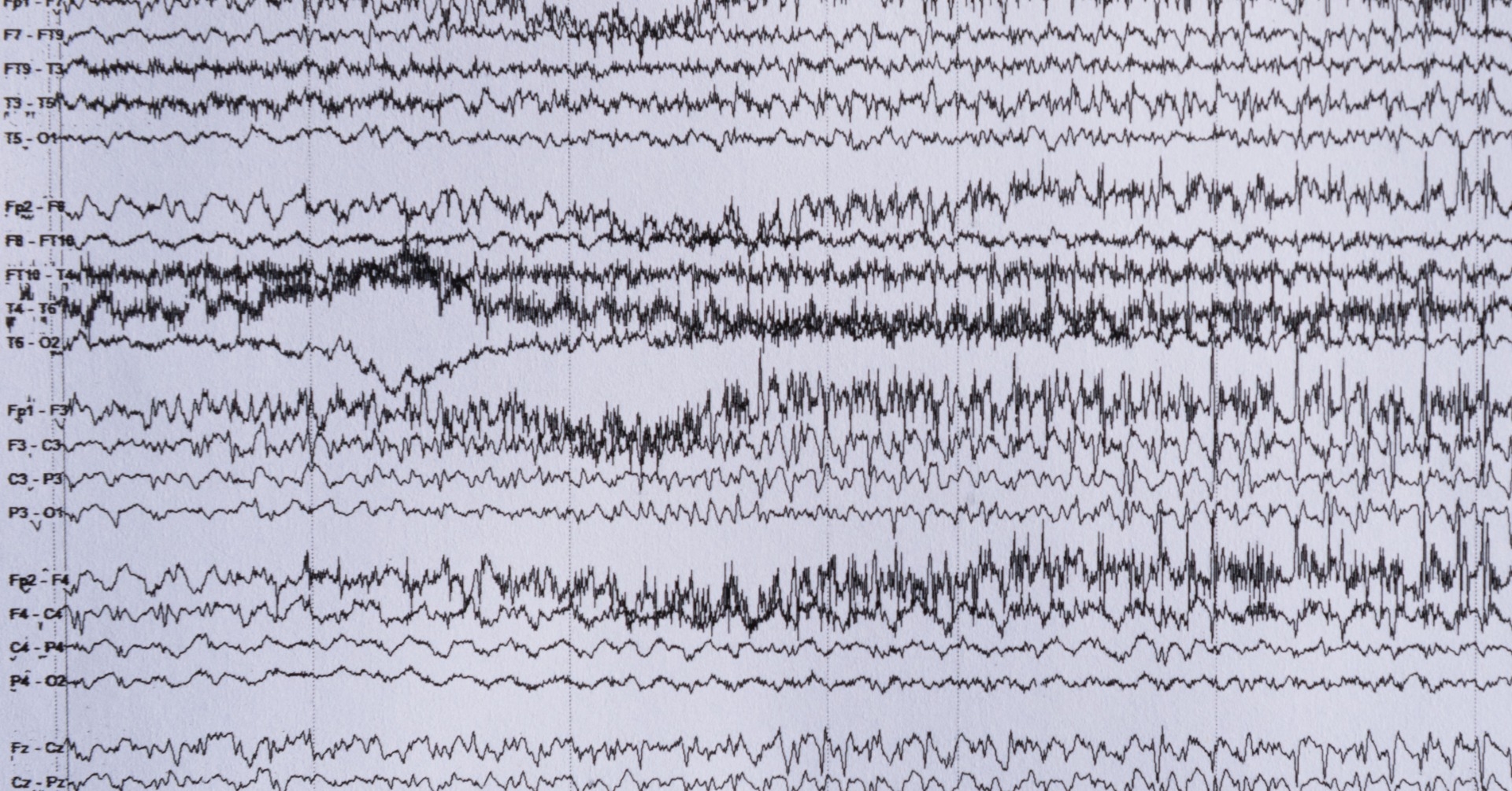 Napady i padaczki odruchowe - czynniki wyzwalające, objawy kliniczne, diagnostyka EEG