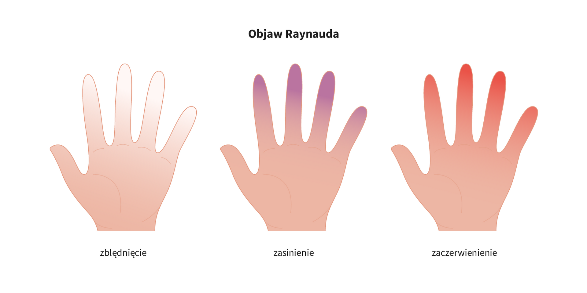 Objaw Raynauda
