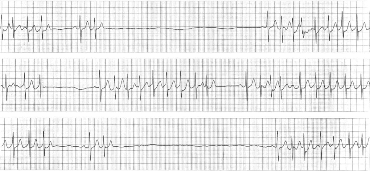<em>Zespół tachykardia–bradykardia.</em>