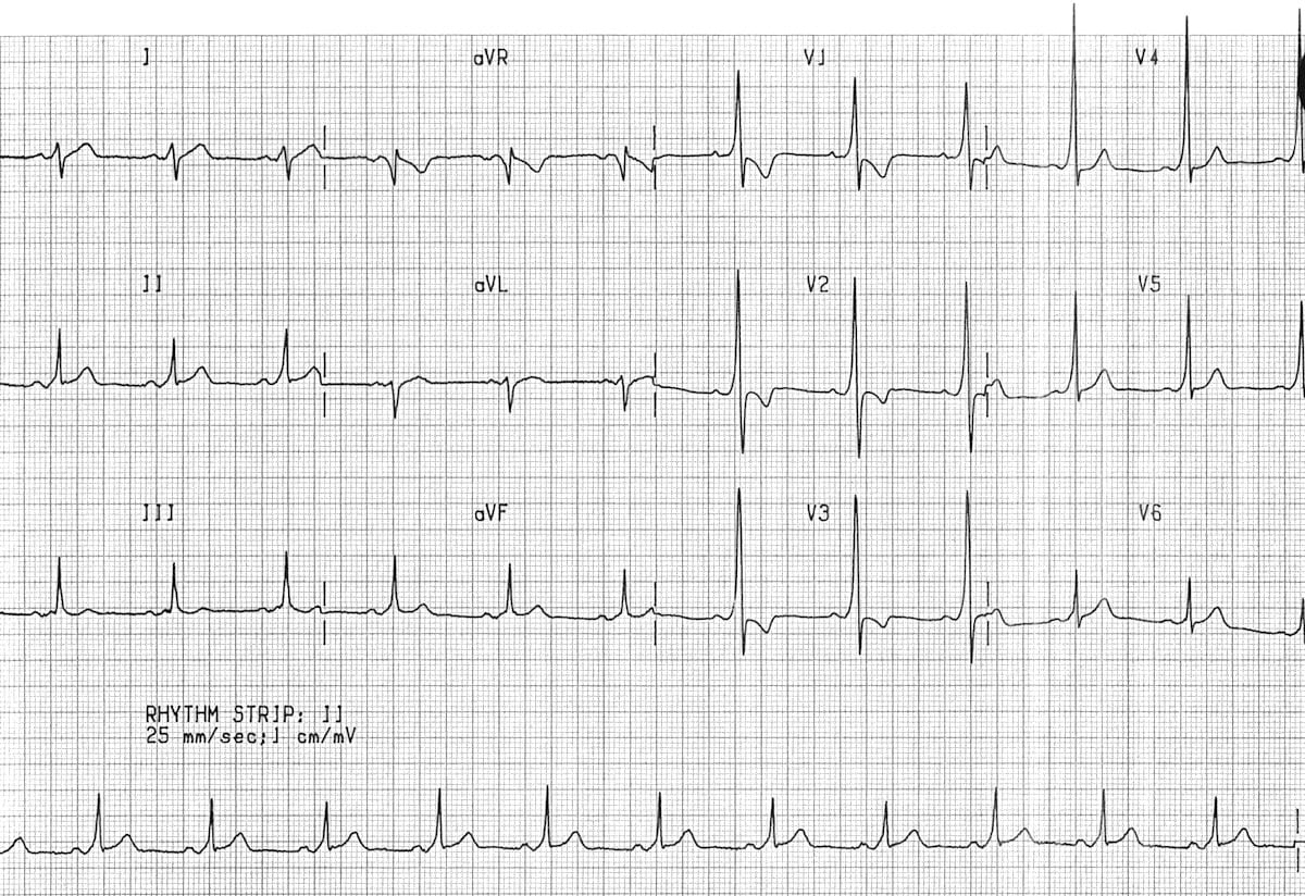 <em>źródło zapisu: </em><a style="border-color: hsl(var(--border)); border-image-source: none; --tw-border-spacing-x: 0; --tw-border-spacing-y: 0; --tw-translate-x: 0; --tw-translate-y: 0; --tw-rotate: 0; --tw-skew-x: 0; --tw-skew-y: 0; --tw-scale-x: 1; --tw-scale-y: 1; --tw-pan-x: ; --tw-pan-y: ; --tw-pinch-zoom: ; --tw-scroll-snap-strictness: proximity; --tw-gradient-from-position: ; --tw-gradient-via-position: ; --tw-gradient-to-position: ; --tw-ordinal: ; --tw-slashed-zero: ; --tw-numeric-figure: ; --tw-numeric-spacing: ; --tw-numeric-fraction: ; --tw-ring-inset: ; --tw-ring-offset-width: 0px; --tw-ring-offset-color: #fff; --tw-ring-color: rgba(59,130,246,0.5); --tw-ring-offset-shadow: 0 0 #0000; --tw-ring-shadow: 0 0 #0000; --tw-shadow: 0 0 #0000; --tw-shadow-colored: 0 0 #0000; --tw-blur: ; --tw-brightness: ; --tw-contrast: ; --tw-grayscale: ; --tw-hue-rotate: ; --tw-invert: ; --tw-saturate: ; --tw-sepia: ; --tw-drop-shadow: ; --tw-backdrop-blur: ; --tw-backdrop-brightness: ; --tw-backdrop-contrast: ; --tw-backdrop-grayscale: ; --tw-backdrop-hue-rotate: ; --tw-backdrop-invert: ; --tw-backdrop-opacity: ; --tw-backdrop-saturate: ; --tw-backdrop-sepia: ; outline-color: currentcolor; outline-style: none; text-decoration-style: solid; text-decoration-color: currentcolor;" href="https://litfl.com/pre-excitation-syndromes-ecg-library/"><span style="border-color: hsl(var(--border)); border-image-source: none; --tw-border-spacing-x: 0; --tw-border-spacing-y: 0; --tw-translate-x: 0; --tw-translate-y: 0; --tw-rotate: 0; --tw-skew-x: 0; --tw-skew-y: 0; --tw-scale-x: 1; --tw-scale-y: 1; --tw-pan-x: ; --tw-pan-y: ; --tw-pinch-zoom: ; --tw-scroll-snap-strictness: proximity; --tw-gradient-from-position: ; --tw-gradient-via-position: ; --tw-gradient-to-position: ; --tw-ordinal: ; --tw-slashed-zero: ; --tw-numeric-figure: ; --tw-numeric-spacing: ; --tw-numeric-fraction: ; --tw-ring-inset: ; --tw-ring-offset-width: 0px; --tw-ring-offset-color: #fff; --tw-ring-color: rgba(59,130,246,0.5); --tw-ring-offset-shadow: 0 0 #0000; --tw-ring-shadow: 0 0 #0000; --tw-shadow: 0 0 #0000; --tw-shadow-colored: 0 0 #0000; --tw-blur: ; --tw-brightness: ; --tw-contrast: ; --tw-grayscale: ; --tw-hue-rotate: ; --tw-invert: ; --tw-saturate: ; --tw-sepia: ; --tw-drop-shadow: ; --tw-backdrop-blur: ; --tw-backdrop-brightness: ; --tw-backdrop-contrast: ; --tw-backdrop-grayscale: ; --tw-backdrop-hue-rotate: ; --tw-backdrop-invert: ; --tw-backdrop-opacity: ; --tw-backdrop-saturate: ; --tw-backdrop-sepia: ; outline-color: currentcolor; outline-style: none; font-size: 11pt; font-family: Arial, sans-serif; color: rgb(17, 85, 204); font-style: italic; font-variant-ligatures: normal; font-variant-alternates: normal; font-variant-numeric: normal; font-variant-east-asian: normal; font-variant-position: normal; text-decoration-skip-ink: none; vertical-align: baseline; white-space: pre-wrap;"></span><em style="border-color: hsl(var(--border)); border-image-source: none; --tw-border-spacing-x: 0; --tw-border-spacing-y: 0; --tw-translate-x: 0; --tw-translate-y: 0; --tw-rotate: 0; --tw-skew-x: 0; --tw-skew-y: 0; --tw-scale-x: 1; --tw-scale-y: 1; --tw-pan-x: ; --tw-pan-y: ; --tw-pinch-zoom: ; --tw-scroll-snap-strictness: proximity; --tw-gradient-from-position: ; --tw-gradient-via-position: ; --tw-gradient-to-position: ; --tw-ordinal: ; --tw-slashed-zero: ; --tw-numeric-figure: ; --tw-numeric-spacing: ; --tw-numeric-fraction: ; --tw-ring-inset: ; --tw-ring-offset-width: 0px; --tw-ring-offset-color: #fff; --tw-ring-color: rgba(59,130,246,0.5); --tw-ring-offset-shadow: 0 0 #0000; --tw-ring-shadow: 0 0 #0000; --tw-shadow: 0 0 #0000; --tw-shadow-colored: 0 0 #0000; --tw-blur: ; --tw-brightness: ; --tw-contrast: ; --tw-grayscale: ; --tw-hue-rotate: ; --tw-invert: ; --tw-saturate: ; --tw-sepia: ; --tw-drop-shadow: ; --tw-backdrop-blur: ; --tw-backdrop-brightness: ; --tw-backdrop-contrast: ; --tw-backdrop-grayscale: ; --tw-backdrop-hue-rotate: ; --tw-backdrop-invert: ; --tw-backdrop-opacity: ; --tw-backdrop-saturate: ; --tw-backdrop-sepia: ; outline-color: currentcolor; outline-style: none;"></em><em></em><em>https://litfl.com/pre-excitation-syndromes-ecg-library/</em></a><em></em>