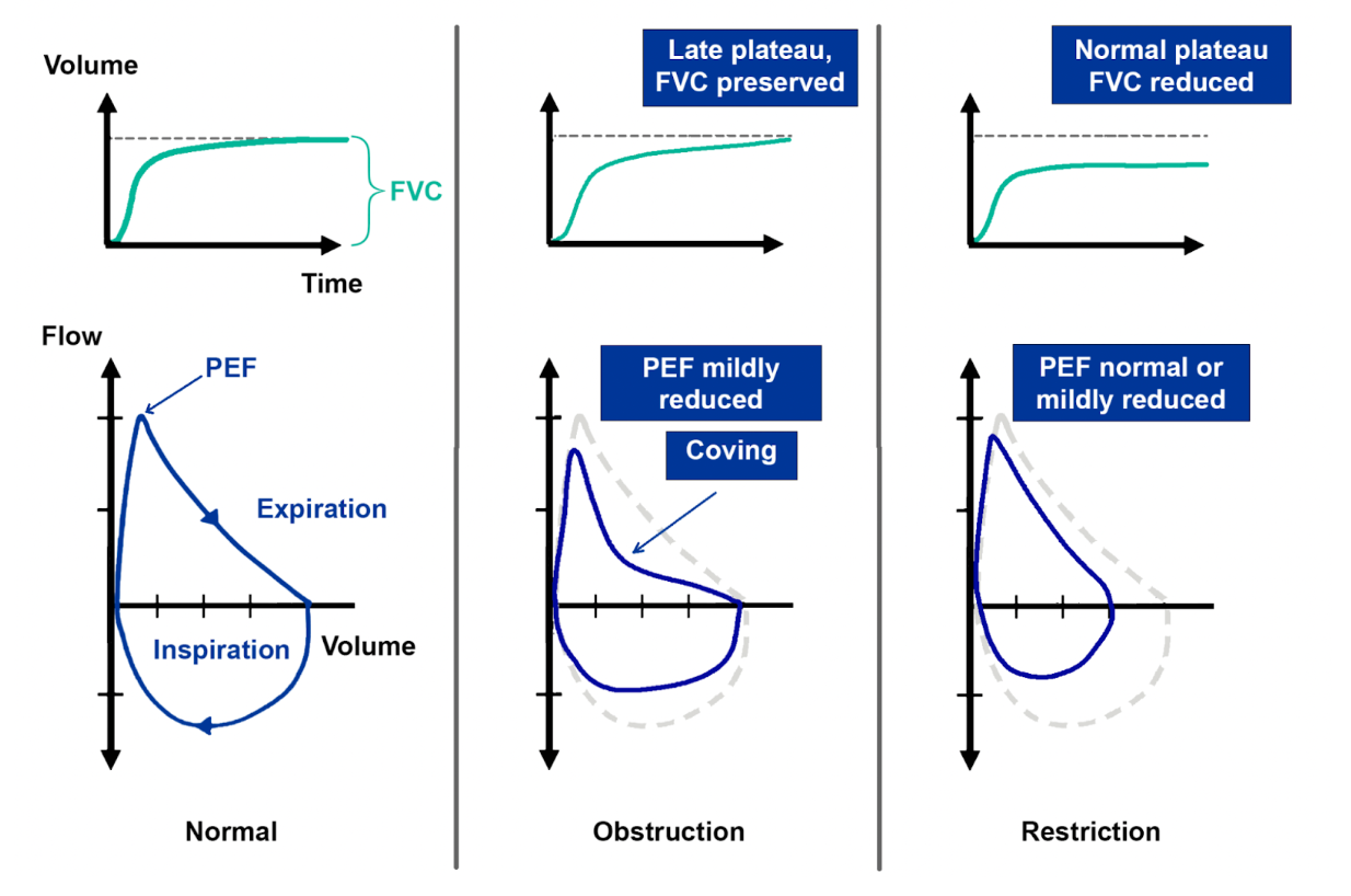 <em>źródło grafiki: </em><a style="--tw-border-spacing-x: 0; --tw-border-spacing-y: 0; --tw-translate-x: 0; --tw-translate-y: 0; --tw-rotate: 0; --tw-skew-x: 0; --tw-skew-y: 0; --tw-scale-x: 1; --tw-scale-y: 1; --tw-pan-x: ; --tw-pan-y: ; --tw-pinch-zoom: ; --tw-scroll-snap-strictness: proximity; --tw-gradient-from-position: ; --tw-gradient-via-position: ; --tw-gradient-to-position: ; --tw-ordinal: ; --tw-slashed-zero: ; --tw-numeric-figure: ; --tw-numeric-spacing: ; --tw-numeric-fraction: ; --tw-ring-inset: ; --tw-ring-offset-width: 0px; --tw-ring-offset-color: #fff; --tw-ring-color: rgba(59,130,246,0.5); --tw-ring-offset-shadow: 0 0 #0000; --tw-ring-shadow: 0 0 #0000; --tw-shadow: 0 0 #0000; --tw-shadow-colored: 0 0 #0000; --tw-blur: ; --tw-brightness: ; --tw-contrast: ; --tw-grayscale: ; --tw-hue-rotate: ; --tw-invert: ; --tw-saturate: ; --tw-sepia: ; --tw-drop-shadow: ; --tw-backdrop-blur: ; --tw-backdrop-brightness: ; --tw-backdrop-contrast: ; --tw-backdrop-grayscale: ; --tw-backdrop-hue-rotate: ; --tw-backdrop-invert: ; --tw-backdrop-opacity: ; --tw-backdrop-saturate: ; --tw-backdrop-sepia: ; border-color: hsl(var(--border)); border-image-source: none; outline-color: currentcolor; outline-style: none; text-decoration-style: solid; text-decoration-color: currentcolor;" href="https://www.medikro.com/understanding-your-spirometry-test-results"><span style="--tw-border-spacing-x: 0; --tw-border-spacing-y: 0; --tw-translate-x: 0; --tw-translate-y: 0; --tw-rotate: 0; --tw-skew-x: 0; --tw-skew-y: 0; --tw-scale-x: 1; --tw-scale-y: 1; --tw-pan-x: ; --tw-pan-y: ; --tw-pinch-zoom: ; --tw-scroll-snap-strictness: proximity; --tw-gradient-from-position: ; --tw-gradient-via-position: ; --tw-gradient-to-position: ; --tw-ordinal: ; --tw-slashed-zero: ; --tw-numeric-figure: ; --tw-numeric-spacing: ; --tw-numeric-fraction: ; --tw-ring-inset: ; --tw-ring-offset-width: 0px; --tw-ring-offset-color: #fff; --tw-ring-color: rgba(59,130,246,0.5); --tw-ring-offset-shadow: 0 0 #0000; --tw-ring-shadow: 0 0 #0000; --tw-shadow: 0 0 #0000; --tw-shadow-colored: 0 0 #0000; --tw-blur: ; --tw-brightness: ; --tw-contrast: ; --tw-grayscale: ; --tw-hue-rotate: ; --tw-invert: ; --tw-saturate: ; --tw-sepia: ; --tw-drop-shadow: ; --tw-backdrop-blur: ; --tw-backdrop-brightness: ; --tw-backdrop-contrast: ; --tw-backdrop-grayscale: ; --tw-backdrop-hue-rotate: ; --tw-backdrop-invert: ; --tw-backdrop-opacity: ; --tw-backdrop-saturate: ; --tw-backdrop-sepia: ; border-color: hsl(var(--border)); border-image-source: none; outline-color: currentcolor; outline-style: none; font-size: 11pt; font-family: Arial, sans-serif; color: rgb(17, 85, 204); font-style: italic; font-variant-ligatures: normal; font-variant-alternates: normal; font-variant-numeric: normal; font-variant-east-asian: normal; font-variant-position: normal; text-decoration-skip-ink: none; vertical-align: baseline; white-space: pre-wrap;"></span><em style="--tw-border-spacing-x: 0; --tw-border-spacing-y: 0; --tw-translate-x: 0; --tw-translate-y: 0; --tw-rotate: 0; --tw-skew-x: 0; --tw-skew-y: 0; --tw-scale-x: 1; --tw-scale-y: 1; --tw-pan-x: ; --tw-pan-y: ; --tw-pinch-zoom: ; --tw-scroll-snap-strictness: proximity; --tw-gradient-from-position: ; --tw-gradient-via-position: ; --tw-gradient-to-position: ; --tw-ordinal: ; --tw-slashed-zero: ; --tw-numeric-figure: ; --tw-numeric-spacing: ; --tw-numeric-fraction: ; --tw-ring-inset: ; --tw-ring-offset-width: 0px; --tw-ring-offset-color: #fff; --tw-ring-color: rgba(59,130,246,0.5); --tw-ring-offset-shadow: 0 0 #0000; --tw-ring-shadow: 0 0 #0000; --tw-shadow: 0 0 #0000; --tw-shadow-colored: 0 0 #0000; --tw-blur: ; --tw-brightness: ; --tw-contrast: ; --tw-grayscale: ; --tw-hue-rotate: ; --tw-invert: ; --tw-saturate: ; --tw-sepia: ; --tw-drop-shadow: ; --tw-backdrop-blur: ; --tw-backdrop-brightness: ; --tw-backdrop-contrast: ; --tw-backdrop-grayscale: ; --tw-backdrop-hue-rotate: ; --tw-backdrop-invert: ; --tw-backdrop-opacity: ; --tw-backdrop-saturate: ; --tw-backdrop-sepia: ; border-color: hsl(var(--border)); border-image-source: none; outline-color: currentcolor; outline-style: none;"></em><em></em><em>https://www.medikro.com/understanding-your-spirometry-test-results</em></a><em> [ostatni dostęp: 20.10.2025 r.]</em>