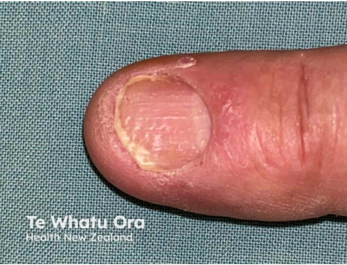 <em>źródło zdjęcia: </em><a style="text-decoration: none;" href="https://dermnetnz.org/assets/Uploads/psoriasis-03.jpg"><span style="font-size: 11pt; font-family: Arial, sans-serif; color: rgb(17, 85, 204); font-style: italic; font-variant-ligatures: normal; font-variant-alternates: normal; font-variant-numeric: normal; font-variant-east-asian: normal; font-variant-position: normal; text-decoration: underline; text-decoration-skip-ink: none; vertical-align: baseline; white-space: pre-wrap;"></span><em>https://dermnetnz.org/assets/Uploads/psoriasis-03.jpg</em></a><em></em>