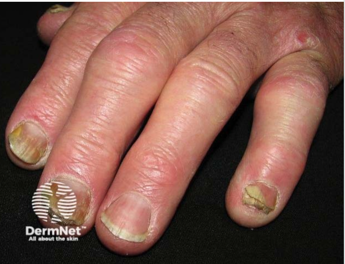 <em>źródło zdjęcia: </em><a style="text-decoration: none;" href="https://dermnetnz.org/assets/Uploads/scaly/nail-psoriasis/3260.jpg"><span style="font-size: 11pt; font-family: Arial, sans-serif; color: rgb(17, 85, 204); font-style: italic; font-variant-ligatures: normal; font-variant-alternates: normal; font-variant-numeric: normal; font-variant-east-asian: normal; font-variant-position: normal; text-decoration: underline; text-decoration-skip-ink: none; vertical-align: baseline; white-space: pre-wrap;"></span><em>https://dermnetnz.org/assets/Uploads/scaly/nail-psoriasis/3260.jpg</em></a><em></em>