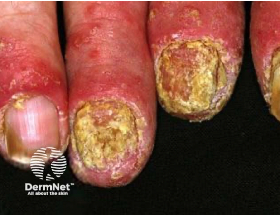 <em>źródło zdjęcia: </em><a style="text-decoration: none;" href="https://dermnetnz.org/assets/Uploads/scaly/nail-psoriasis/3260.jpg"><span style="font-size: 11pt; font-family: Arial, sans-serif; color: rgb(17, 85, 204); font-style: italic; font-variant-ligatures: normal; font-variant-alternates: normal; font-variant-numeric: normal; font-variant-east-asian: normal; font-variant-position: normal; text-decoration: underline; text-decoration-skip-ink: none; vertical-align: baseline; white-space: pre-wrap;"></span><em>https://dermnetnz.org/assets/Uploads/scaly/nail-psoriasis/3260.jpg</em></a><em></em>
