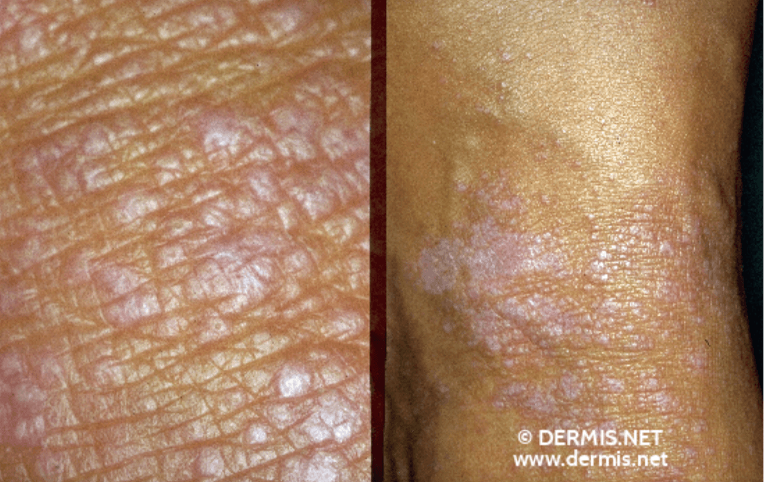 <em>źródło zdjęcia: </em><a style="--tw-border-spacing-x: 0; --tw-border-spacing-y: 0; --tw-translate-x: 0; --tw-translate-y: 0; --tw-rotate: 0; --tw-skew-x: 0; --tw-skew-y: 0; --tw-scale-x: 1; --tw-scale-y: 1; --tw-pan-x: ; --tw-pan-y: ; --tw-pinch-zoom: ; --tw-scroll-snap-strictness: proximity; --tw-gradient-from-position: ; --tw-gradient-via-position: ; --tw-gradient-to-position: ; --tw-ordinal: ; --tw-slashed-zero: ; --tw-numeric-figure: ; --tw-numeric-spacing: ; --tw-numeric-fraction: ; --tw-ring-inset: ; --tw-ring-offset-width: 0px; --tw-ring-offset-color: #fff; --tw-ring-color: rgba(59,130,246,0.5); --tw-ring-offset-shadow: 0 0 #0000; --tw-ring-shadow: 0 0 #0000; --tw-shadow: 0 0 #0000; --tw-shadow-colored: 0 0 #0000; --tw-blur: ; --tw-brightness: ; --tw-contrast: ; --tw-grayscale: ; --tw-hue-rotate: ; --tw-invert: ; --tw-saturate: ; --tw-sepia: ; --tw-drop-shadow: ; --tw-backdrop-blur: ; --tw-backdrop-brightness: ; --tw-backdrop-contrast: ; --tw-backdrop-grayscale: ; --tw-backdrop-hue-rotate: ; --tw-backdrop-invert: ; --tw-backdrop-opacity: ; --tw-backdrop-saturate: ; --tw-backdrop-sepia: ; border-color: hsl(var(--border)); border-image-source: none; outline-color: currentcolor; outline-style: none; text-decoration-style: solid; text-decoration-color: currentcolor;" href="https://www.dermis.net/dermisroot/en/32916/image.htm"><span style="--tw-border-spacing-x: 0; --tw-border-spacing-y: 0; --tw-translate-x: 0; --tw-translate-y: 0; --tw-rotate: 0; --tw-skew-x: 0; --tw-skew-y: 0; --tw-scale-x: 1; --tw-scale-y: 1; --tw-pan-x: ; --tw-pan-y: ; --tw-pinch-zoom: ; --tw-scroll-snap-strictness: proximity; --tw-gradient-from-position: ; --tw-gradient-via-position: ; --tw-gradient-to-position: ; --tw-ordinal: ; --tw-slashed-zero: ; --tw-numeric-figure: ; --tw-numeric-spacing: ; --tw-numeric-fraction: ; --tw-ring-inset: ; --tw-ring-offset-width: 0px; --tw-ring-offset-color: #fff; --tw-ring-color: rgba(59,130,246,0.5); --tw-ring-offset-shadow: 0 0 #0000; --tw-ring-shadow: 0 0 #0000; --tw-shadow: 0 0 #0000; --tw-shadow-colored: 0 0 #0000; --tw-blur: ; --tw-brightness: ; --tw-contrast: ; --tw-grayscale: ; --tw-hue-rotate: ; --tw-invert: ; --tw-saturate: ; --tw-sepia: ; --tw-drop-shadow: ; --tw-backdrop-blur: ; --tw-backdrop-brightness: ; --tw-backdrop-contrast: ; --tw-backdrop-grayscale: ; --tw-backdrop-hue-rotate: ; --tw-backdrop-invert: ; --tw-backdrop-opacity: ; --tw-backdrop-saturate: ; --tw-backdrop-sepia: ; border-color: hsl(var(--border)); border-image-source: none; outline-color: currentcolor; outline-style: none; font-size: 11pt; font-family: Arial, sans-serif; color: rgb(17, 85, 204); font-style: italic; font-variant-ligatures: normal; font-variant-alternates: normal; font-variant-numeric: normal; font-variant-east-asian: normal; font-variant-position: normal; text-decoration-skip-ink: none; vertical-align: baseline; white-space: pre-wrap;"></span><em style="--tw-border-spacing-x: 0; --tw-border-spacing-y: 0; --tw-translate-x: 0; --tw-translate-y: 0; --tw-rotate: 0; --tw-skew-x: 0; --tw-skew-y: 0; --tw-scale-x: 1; --tw-scale-y: 1; --tw-pan-x: ; --tw-pan-y: ; --tw-pinch-zoom: ; --tw-scroll-snap-strictness: proximity; --tw-gradient-from-position: ; --tw-gradient-via-position: ; --tw-gradient-to-position: ; --tw-ordinal: ; --tw-slashed-zero: ; --tw-numeric-figure: ; --tw-numeric-spacing: ; --tw-numeric-fraction: ; --tw-ring-inset: ; --tw-ring-offset-width: 0px; --tw-ring-offset-color: #fff; --tw-ring-color: rgba(59,130,246,0.5); --tw-ring-offset-shadow: 0 0 #0000; --tw-ring-shadow: 0 0 #0000; --tw-shadow: 0 0 #0000; --tw-shadow-colored: 0 0 #0000; --tw-blur: ; --tw-brightness: ; --tw-contrast: ; --tw-grayscale: ; --tw-hue-rotate: ; --tw-invert: ; --tw-saturate: ; --tw-sepia: ; --tw-drop-shadow: ; --tw-backdrop-blur: ; --tw-backdrop-brightness: ; --tw-backdrop-contrast: ; --tw-backdrop-grayscale: ; --tw-backdrop-hue-rotate: ; --tw-backdrop-invert: ; --tw-backdrop-opacity: ; --tw-backdrop-saturate: ; --tw-backdrop-sepia: ; border-color: hsl(var(--border)); border-image-source: none; outline-color: currentcolor; outline-style: none;"></em><em></em><em>https://www.dermis.net/dermisroot/en/32916/image.htm</em></a><em></em>