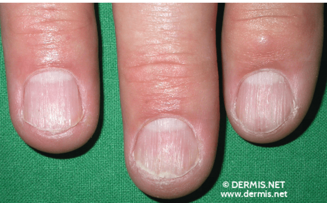 <em>źródło zdjęcia: </em><a style="--tw-border-spacing-x: 0; --tw-border-spacing-y: 0; --tw-translate-x: 0; --tw-translate-y: 0; --tw-rotate: 0; --tw-skew-x: 0; --tw-skew-y: 0; --tw-scale-x: 1; --tw-scale-y: 1; --tw-pan-x: ; --tw-pan-y: ; --tw-pinch-zoom: ; --tw-scroll-snap-strictness: proximity; --tw-gradient-from-position: ; --tw-gradient-via-position: ; --tw-gradient-to-position: ; --tw-ordinal: ; --tw-slashed-zero: ; --tw-numeric-figure: ; --tw-numeric-spacing: ; --tw-numeric-fraction: ; --tw-ring-inset: ; --tw-ring-offset-width: 0px; --tw-ring-offset-color: #fff; --tw-ring-color: rgba(59,130,246,0.5); --tw-ring-offset-shadow: 0 0 #0000; --tw-ring-shadow: 0 0 #0000; --tw-shadow: 0 0 #0000; --tw-shadow-colored: 0 0 #0000; --tw-blur: ; --tw-brightness: ; --tw-contrast: ; --tw-grayscale: ; --tw-hue-rotate: ; --tw-invert: ; --tw-saturate: ; --tw-sepia: ; --tw-drop-shadow: ; --tw-backdrop-blur: ; --tw-backdrop-brightness: ; --tw-backdrop-contrast: ; --tw-backdrop-grayscale: ; --tw-backdrop-hue-rotate: ; --tw-backdrop-invert: ; --tw-backdrop-opacity: ; --tw-backdrop-saturate: ; --tw-backdrop-sepia: ; border-color: hsl(var(--border)); border-image-source: none; outline-color: currentcolor; outline-style: none; text-decoration-style: solid; text-decoration-color: currentcolor;" href="https://www.dermis.net/dermisroot/en/1197234/image.htm"><span style="--tw-border-spacing-x: 0; --tw-border-spacing-y: 0; --tw-translate-x: 0; --tw-translate-y: 0; --tw-rotate: 0; --tw-skew-x: 0; --tw-skew-y: 0; --tw-scale-x: 1; --tw-scale-y: 1; --tw-pan-x: ; --tw-pan-y: ; --tw-pinch-zoom: ; --tw-scroll-snap-strictness: proximity; --tw-gradient-from-position: ; --tw-gradient-via-position: ; --tw-gradient-to-position: ; --tw-ordinal: ; --tw-slashed-zero: ; --tw-numeric-figure: ; --tw-numeric-spacing: ; --tw-numeric-fraction: ; --tw-ring-inset: ; --tw-ring-offset-width: 0px; --tw-ring-offset-color: #fff; --tw-ring-color: rgba(59,130,246,0.5); --tw-ring-offset-shadow: 0 0 #0000; --tw-ring-shadow: 0 0 #0000; --tw-shadow: 0 0 #0000; --tw-shadow-colored: 0 0 #0000; --tw-blur: ; --tw-brightness: ; --tw-contrast: ; --tw-grayscale: ; --tw-hue-rotate: ; --tw-invert: ; --tw-saturate: ; --tw-sepia: ; --tw-drop-shadow: ; --tw-backdrop-blur: ; --tw-backdrop-brightness: ; --tw-backdrop-contrast: ; --tw-backdrop-grayscale: ; --tw-backdrop-hue-rotate: ; --tw-backdrop-invert: ; --tw-backdrop-opacity: ; --tw-backdrop-saturate: ; --tw-backdrop-sepia: ; border-color: hsl(var(--border)); border-image-source: none; outline-color: currentcolor; outline-style: none; font-size: 11pt; font-family: Arial, sans-serif; color: rgb(17, 85, 204); font-style: italic; font-variant-ligatures: normal; font-variant-alternates: normal; font-variant-numeric: normal; font-variant-east-asian: normal; font-variant-position: normal; text-decoration-skip-ink: none; vertical-align: baseline; white-space: pre-wrap;"></span><em style="--tw-border-spacing-x: 0; --tw-border-spacing-y: 0; --tw-translate-x: 0; --tw-translate-y: 0; --tw-rotate: 0; --tw-skew-x: 0; --tw-skew-y: 0; --tw-scale-x: 1; --tw-scale-y: 1; --tw-pan-x: ; --tw-pan-y: ; --tw-pinch-zoom: ; --tw-scroll-snap-strictness: proximity; --tw-gradient-from-position: ; --tw-gradient-via-position: ; --tw-gradient-to-position: ; --tw-ordinal: ; --tw-slashed-zero: ; --tw-numeric-figure: ; --tw-numeric-spacing: ; --tw-numeric-fraction: ; --tw-ring-inset: ; --tw-ring-offset-width: 0px; --tw-ring-offset-color: #fff; --tw-ring-color: rgba(59,130,246,0.5); --tw-ring-offset-shadow: 0 0 #0000; --tw-ring-shadow: 0 0 #0000; --tw-shadow: 0 0 #0000; --tw-shadow-colored: 0 0 #0000; --tw-blur: ; --tw-brightness: ; --tw-contrast: ; --tw-grayscale: ; --tw-hue-rotate: ; --tw-invert: ; --tw-saturate: ; --tw-sepia: ; --tw-drop-shadow: ; --tw-backdrop-blur: ; --tw-backdrop-brightness: ; --tw-backdrop-contrast: ; --tw-backdrop-grayscale: ; --tw-backdrop-hue-rotate: ; --tw-backdrop-invert: ; --tw-backdrop-opacity: ; --tw-backdrop-saturate: ; --tw-backdrop-sepia: ; border-color: hsl(var(--border)); border-image-source: none; outline-color: currentcolor; outline-style: none;"></em><em></em><em>https://www.dermis.net/dermisroot/en/1197234/image.htm</em></a><em></em>