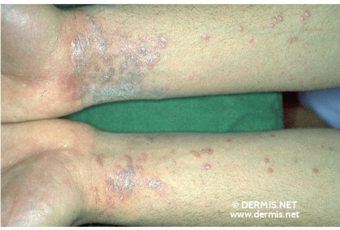 <em>źródło zdjęcia: </em><a style="--tw-border-spacing-x: 0; --tw-border-spacing-y: 0; --tw-translate-x: 0; --tw-translate-y: 0; --tw-rotate: 0; --tw-skew-x: 0; --tw-skew-y: 0; --tw-scale-x: 1; --tw-scale-y: 1; --tw-pan-x: ; --tw-pan-y: ; --tw-pinch-zoom: ; --tw-scroll-snap-strictness: proximity; --tw-gradient-from-position: ; --tw-gradient-via-position: ; --tw-gradient-to-position: ; --tw-ordinal: ; --tw-slashed-zero: ; --tw-numeric-figure: ; --tw-numeric-spacing: ; --tw-numeric-fraction: ; --tw-ring-inset: ; --tw-ring-offset-width: 0px; --tw-ring-offset-color: #fff; --tw-ring-color: rgba(59,130,246,0.5); --tw-ring-offset-shadow: 0 0 #0000; --tw-ring-shadow: 0 0 #0000; --tw-shadow: 0 0 #0000; --tw-shadow-colored: 0 0 #0000; --tw-blur: ; --tw-brightness: ; --tw-contrast: ; --tw-grayscale: ; --tw-hue-rotate: ; --tw-invert: ; --tw-saturate: ; --tw-sepia: ; --tw-drop-shadow: ; --tw-backdrop-blur: ; --tw-backdrop-brightness: ; --tw-backdrop-contrast: ; --tw-backdrop-grayscale: ; --tw-backdrop-hue-rotate: ; --tw-backdrop-invert: ; --tw-backdrop-opacity: ; --tw-backdrop-saturate: ; --tw-backdrop-sepia: ; border-color: hsl(var(--border)); border-image-source: none; outline-color: currentcolor; outline-style: none; text-decoration-style: solid; text-decoration-color: currentcolor;" href="https://www.dermis.net/dermisroot/en/32945/image.htm"><span style="--tw-border-spacing-x: 0; --tw-border-spacing-y: 0; --tw-translate-x: 0; --tw-translate-y: 0; --tw-rotate: 0; --tw-skew-x: 0; --tw-skew-y: 0; --tw-scale-x: 1; --tw-scale-y: 1; --tw-pan-x: ; --tw-pan-y: ; --tw-pinch-zoom: ; --tw-scroll-snap-strictness: proximity; --tw-gradient-from-position: ; --tw-gradient-via-position: ; --tw-gradient-to-position: ; --tw-ordinal: ; --tw-slashed-zero: ; --tw-numeric-figure: ; --tw-numeric-spacing: ; --tw-numeric-fraction: ; --tw-ring-inset: ; --tw-ring-offset-width: 0px; --tw-ring-offset-color: #fff; --tw-ring-color: rgba(59,130,246,0.5); --tw-ring-offset-shadow: 0 0 #0000; --tw-ring-shadow: 0 0 #0000; --tw-shadow: 0 0 #0000; --tw-shadow-colored: 0 0 #0000; --tw-blur: ; --tw-brightness: ; --tw-contrast: ; --tw-grayscale: ; --tw-hue-rotate: ; --tw-invert: ; --tw-saturate: ; --tw-sepia: ; --tw-drop-shadow: ; --tw-backdrop-blur: ; --tw-backdrop-brightness: ; --tw-backdrop-contrast: ; --tw-backdrop-grayscale: ; --tw-backdrop-hue-rotate: ; --tw-backdrop-invert: ; --tw-backdrop-opacity: ; --tw-backdrop-saturate: ; --tw-backdrop-sepia: ; border-color: hsl(var(--border)); border-image-source: none; outline-color: currentcolor; outline-style: none; font-size: 11pt; font-family: Arial, sans-serif; color: rgb(17, 85, 204); font-style: italic; font-variant-ligatures: normal; font-variant-alternates: normal; font-variant-numeric: normal; font-variant-east-asian: normal; font-variant-position: normal; text-decoration-skip-ink: none; vertical-align: baseline; white-space: pre-wrap;"></span><em style="--tw-border-spacing-x: 0; --tw-border-spacing-y: 0; --tw-translate-x: 0; --tw-translate-y: 0; --tw-rotate: 0; --tw-skew-x: 0; --tw-skew-y: 0; --tw-scale-x: 1; --tw-scale-y: 1; --tw-pan-x: ; --tw-pan-y: ; --tw-pinch-zoom: ; --tw-scroll-snap-strictness: proximity; --tw-gradient-from-position: ; --tw-gradient-via-position: ; --tw-gradient-to-position: ; --tw-ordinal: ; --tw-slashed-zero: ; --tw-numeric-figure: ; --tw-numeric-spacing: ; --tw-numeric-fraction: ; --tw-ring-inset: ; --tw-ring-offset-width: 0px; --tw-ring-offset-color: #fff; --tw-ring-color: rgba(59,130,246,0.5); --tw-ring-offset-shadow: 0 0 #0000; --tw-ring-shadow: 0 0 #0000; --tw-shadow: 0 0 #0000; --tw-shadow-colored: 0 0 #0000; --tw-blur: ; --tw-brightness: ; --tw-contrast: ; --tw-grayscale: ; --tw-hue-rotate: ; --tw-invert: ; --tw-saturate: ; --tw-sepia: ; --tw-drop-shadow: ; --tw-backdrop-blur: ; --tw-backdrop-brightness: ; --tw-backdrop-contrast: ; --tw-backdrop-grayscale: ; --tw-backdrop-hue-rotate: ; --tw-backdrop-invert: ; --tw-backdrop-opacity: ; --tw-backdrop-saturate: ; --tw-backdrop-sepia: ; border-color: hsl(var(--border)); border-image-source: none; outline-color: currentcolor; outline-style: none;"></em><em></em><em>https://www.dermis.net/dermisroot/en/32945/image.htm</em></a><em></em>