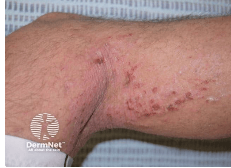 <em>źródło zdjęcia: </em><a style="text-decoration: none;" href="https://dermnetnz.org/imagedetail/10928-atopic-dermatitis"><span style="font-size: 12pt; font-family: "Times New Roman", serif; color: rgb(17, 85, 204); font-style: italic; font-variant-ligatures: normal; font-variant-alternates: normal; font-variant-numeric: normal; font-variant-east-asian: normal; font-variant-position: normal; text-decoration: underline; text-decoration-skip-ink: none; vertical-align: baseline; white-space: pre-wrap;"></span><em>https://dermnetnz.org/imagedetail/10928-atopic-dermatitis</em></a><em></em><br>