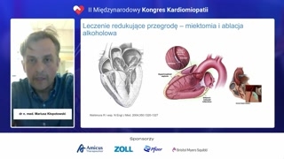 Miektomia chirurgiczna: skuteczność i rokowanie długoterminowe