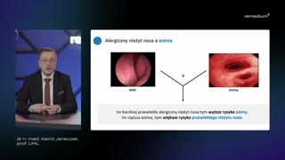 Związek alergicznego nieżytu nosa z astmą