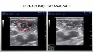 Różnicowanie świeżej i starej zakrzepicy oraz pułapki diagnostyki refluksu