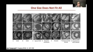 Tissue Characterization for Cardiomyopathy Differentiation