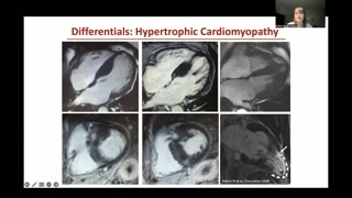 Hypertrophic Cardiomyopathy and Sarcoidosis as Differentials