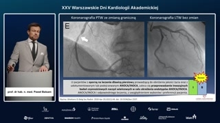 ANOCA i INOCA: definicje, endotypy i częstość