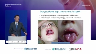 Latencja i nawroty opryszczki
