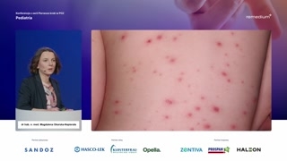 Ospa wietrzna
