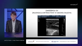 Balotujące skrzepliny i ryzyko zatorowości