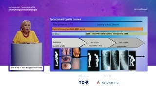Obraz kliniczny, spondylodiscitis i przebieg choroby