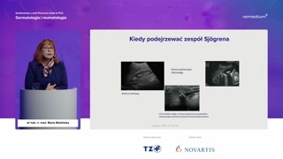 Kiedy podejrzewać zespół Sjögrena