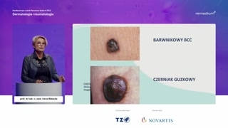 Rak podstawnokomórkowy i wprowadzenie do raka kolczystokomórkowego