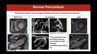CMR techniques to visualize the pericardium