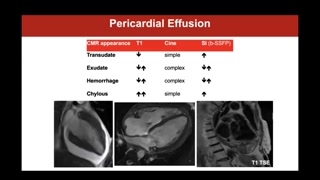 Congenital pericardial absence imaging features