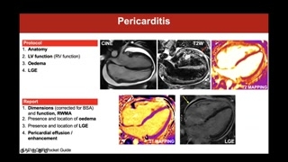 Pericardial effusion characterization on CMR