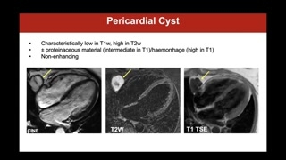 Acute pericarditis: edema, mapping, and enhancement