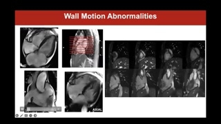 Right ventricular regional wall motion assessment