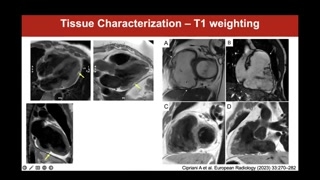 Myocardial fat infiltration and parametric mapping
