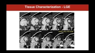 Late gadolinium enhancement patterns and differential diagnosis