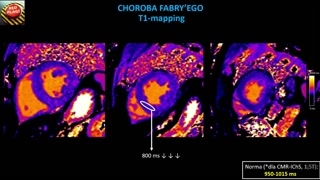 Choroba Fabry'ego, hemochromatoza i podsumowanie