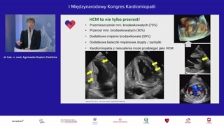 Kardiomiopatia rozstrzeniowa i kardiotoksyczność antracyklin