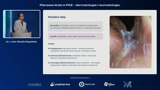 Grzybica stóp — przyczyny i podtypy
