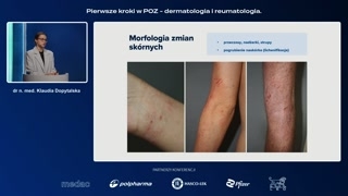 Przebieg choroby i powikłania skórne