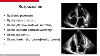 Podstawy echokardiografii i kryteria rozpoznania
