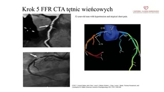 Porównanie metod diagnostycznych, koronarografia i podsumowanie