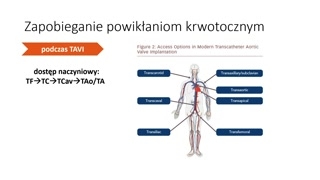Aspekty proceduralne minimalizujące krwawienia