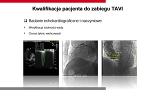 Historia TAVI, kwalifikacja i przygotowanie pacjenta