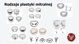 Wskazania i korzyści wczesnej naprawy zastawki mitralnej
