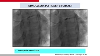 Migotanie przedsionków, terapia potrójna i podsumowanie zaleceń