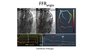 QFR: technika, badania i zastosowanie kliniczne
