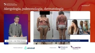 Wprowadzenie i podstawy łuszczycy plackowatej