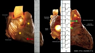 Anatomia ognisk arytmii i lokalizacje łagodnych pobudzeń