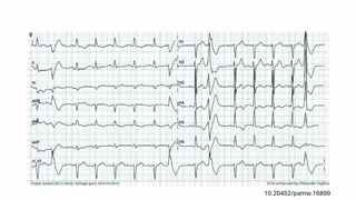 Przypadki kliniczne: arytmia z prawej komory i różnicowanie z sarkoidozą