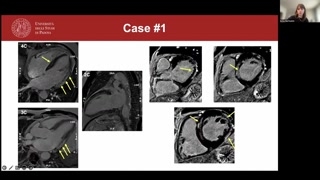 T2 imaging, edema patterns and mapping techniques